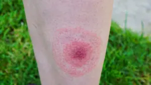 Νόσος Lyme: Συμπτώματα, αιτίες και πρόληψη