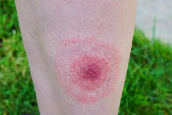 Νόσος Lyme: Συμπτώματα, αιτίες και πρόληψη