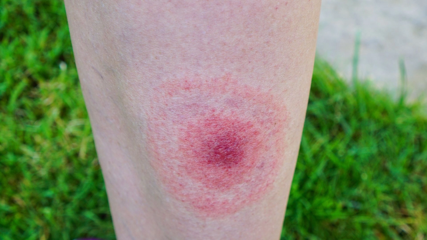 Νόσος Lyme: Συμπτώματα, αιτίες και πρόληψη